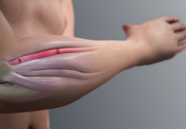 How to treat Tennis Elbow